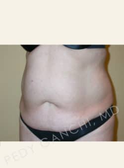 Tummy Tuck