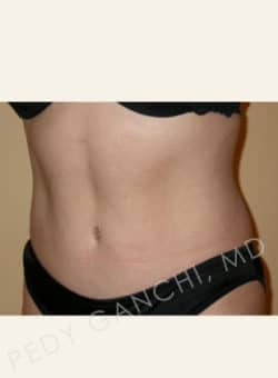 Tummy Tuck