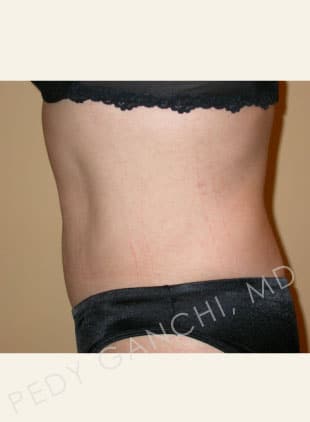 Tummy Tuck