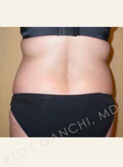 Tummy Tuck