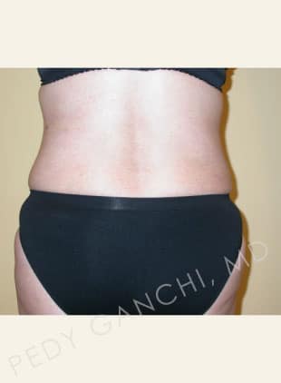 Tummy Tuck