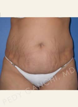 Tummy Tuck