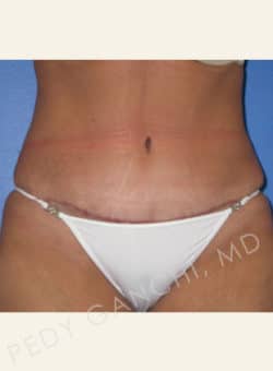 Tummy Tuck
