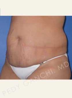 Tummy Tuck