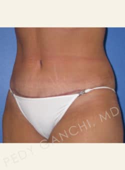 Tummy Tuck