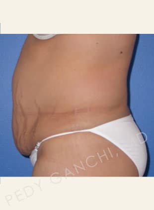 Tummy Tuck