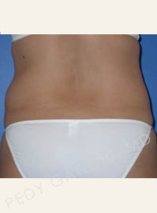 Tummy Tuck