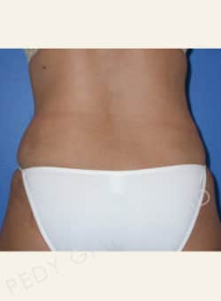 Tummy Tuck