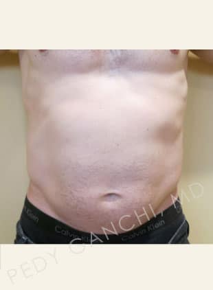 Liposuction