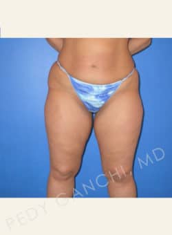 Liposuction