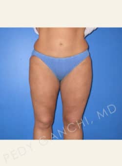 Liposuction