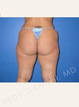 Liposuction