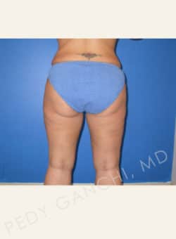 Liposuction