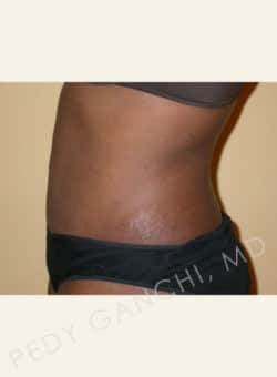 Liposuction