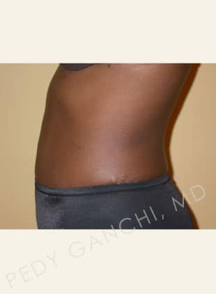 Liposuction