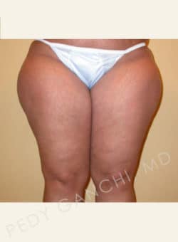 Liposuction