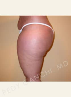 Liposuction