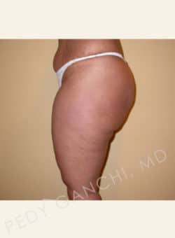 Liposuction