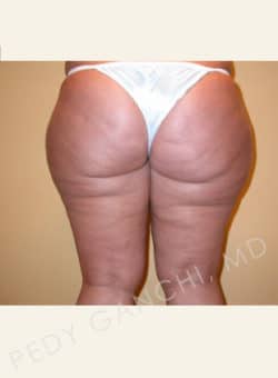 Liposuction