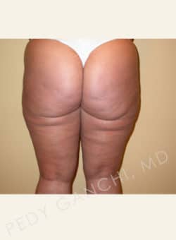 Liposuction