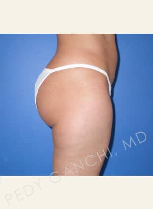 Liposuction