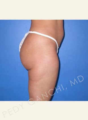 Liposuction