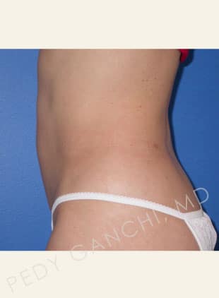 Liposuction