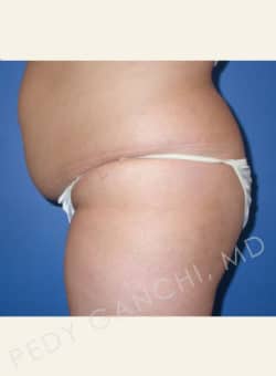 Liposuction