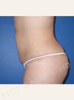 Liposuction