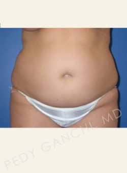 Liposuction