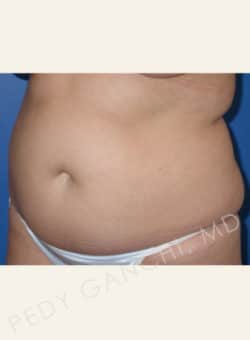 Liposuction