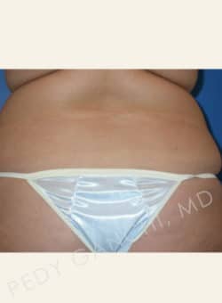 Liposuction