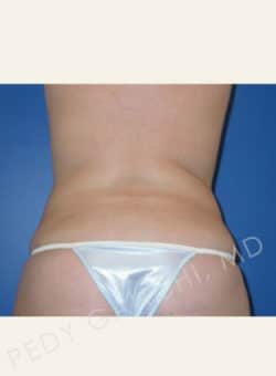 Liposuction