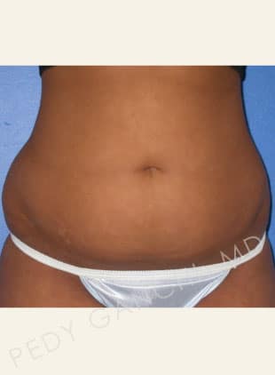 Liposuction