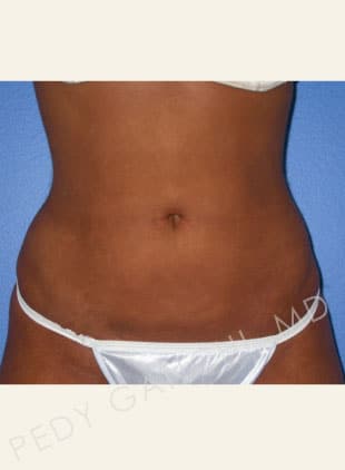 Liposuction