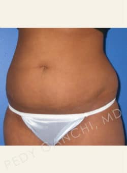 Liposuction