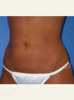 Liposuction