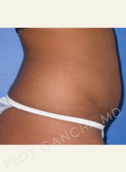 Liposuction