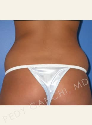 Liposuction