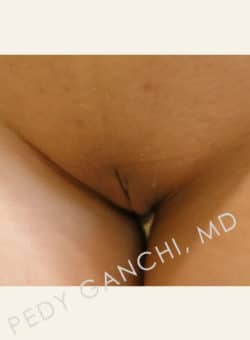 Labiaplasty