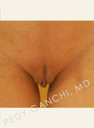 Labiaplasty