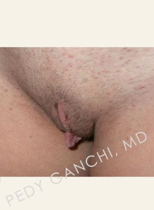 Labiaplasty