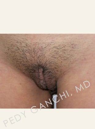 Labiaplasty