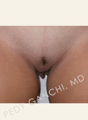 Labiaplasty