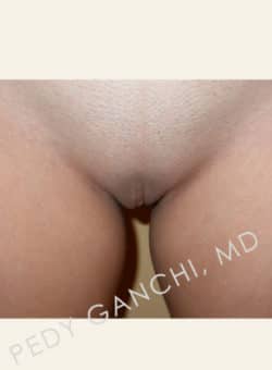 Labiaplasty