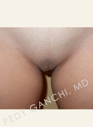 Labiaplasty