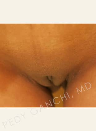 Labiaplasty