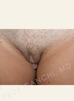 Labiaplasty