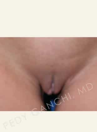 Labiaplasty