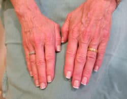 Hand Rejuvenation